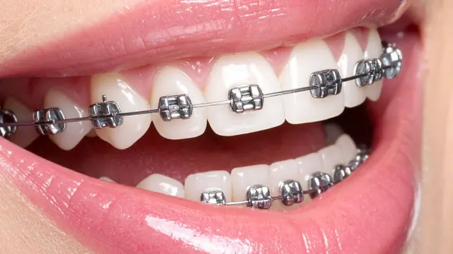 Braces on teeth