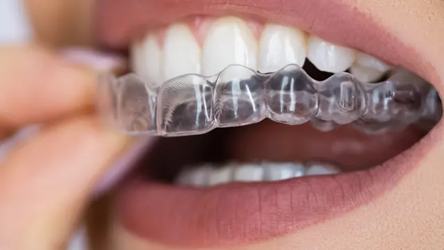 Clear aligner tray