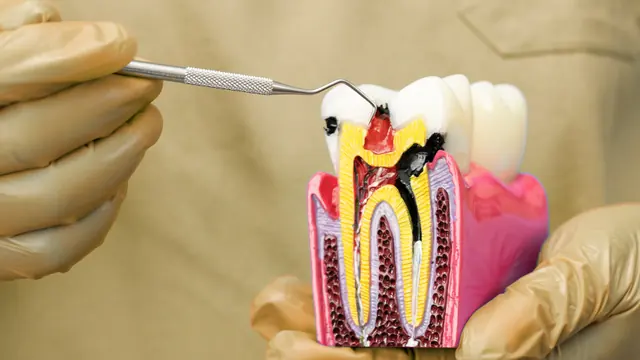 Root canal tooth model