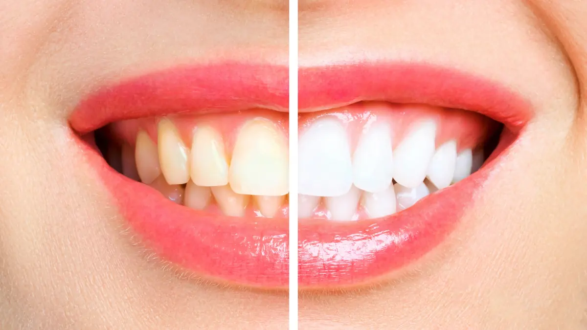 Split image comparing teeth before and after whitening