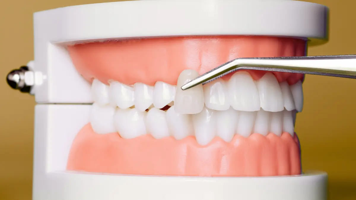 Dental instrument touching a veneer on a tooth model